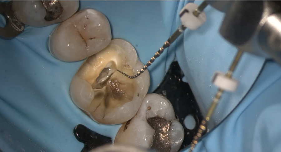 Ultimate problem solving: A hands-on endodontic course